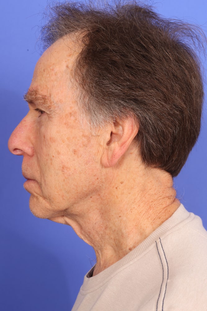 Neck Lift Before & After Image