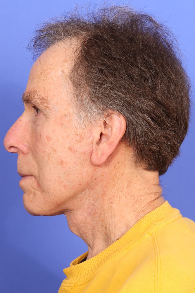 Neck Lift Before & After Image