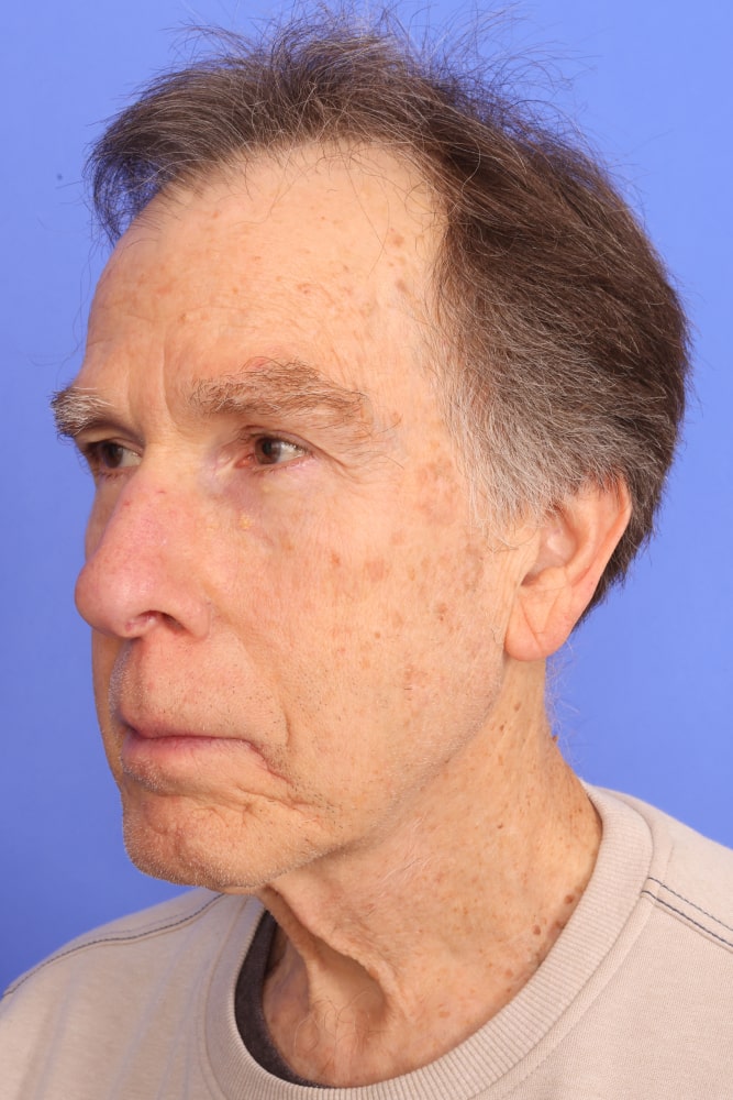 Neck Lift Before & After Image