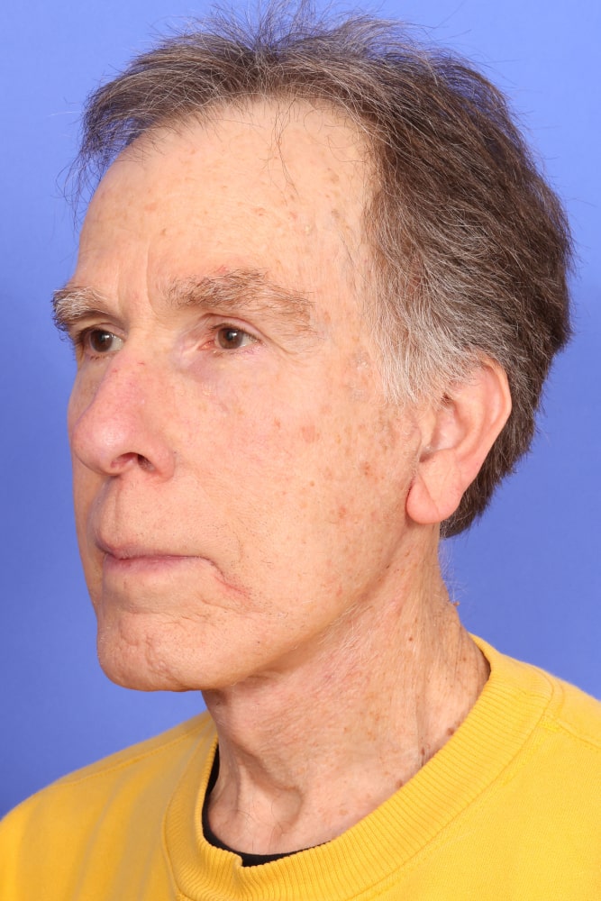 Neck Lift Before & After Image