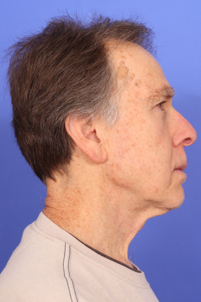 Neck Lift Before & After Image