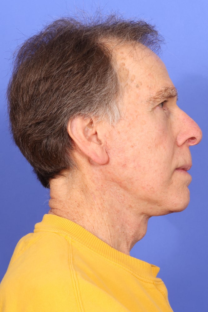 Neck Lift Before & After Image