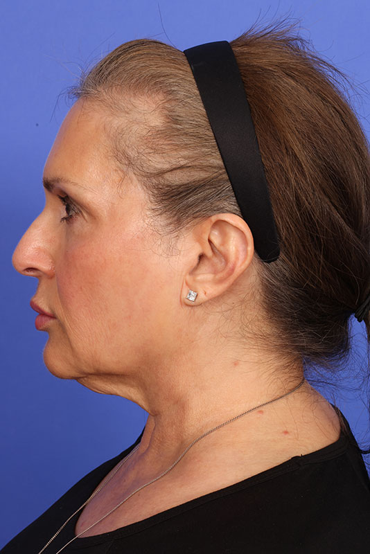 Neck Lift Before & After Image