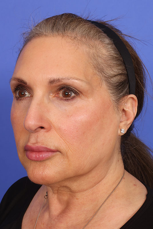 Neck Lift Before & After Image