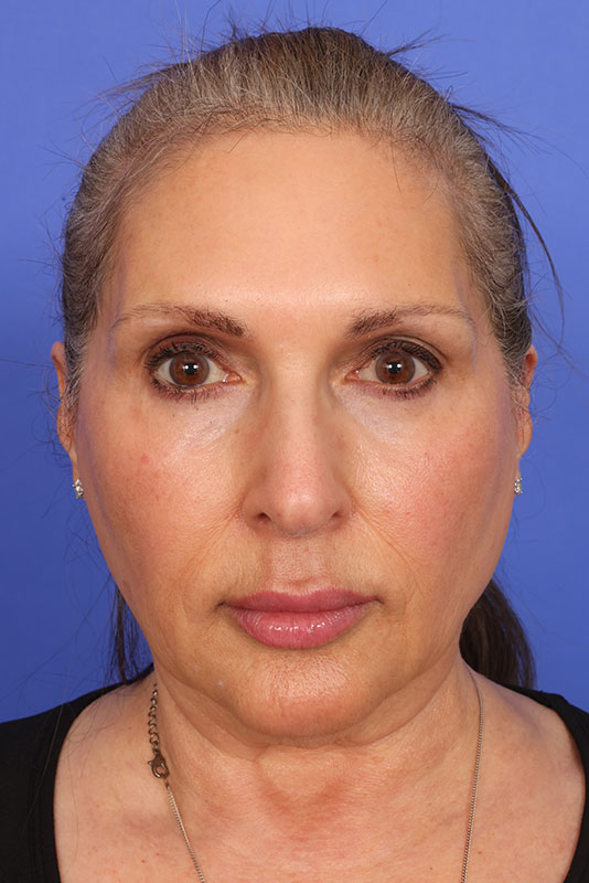 Neck Lift Before & After Image