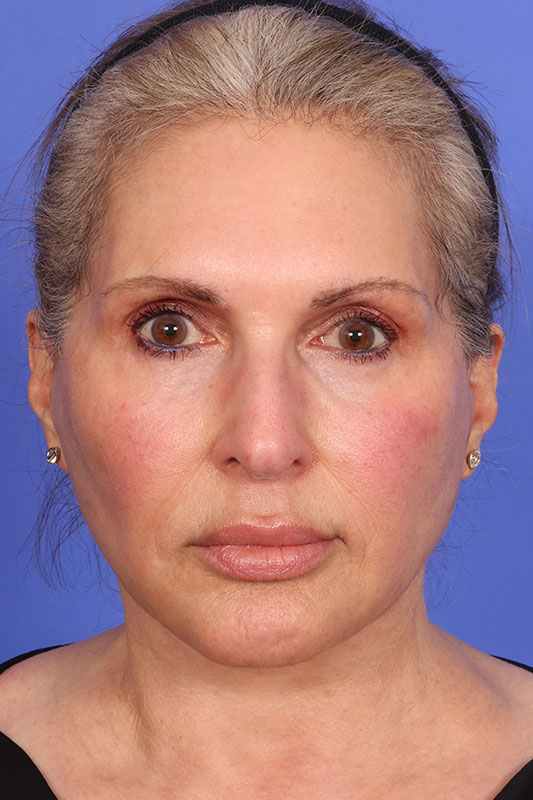 Neck Lift Before & After Image