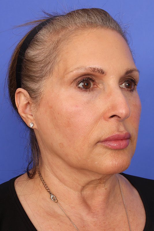 Neck Lift Before & After Image