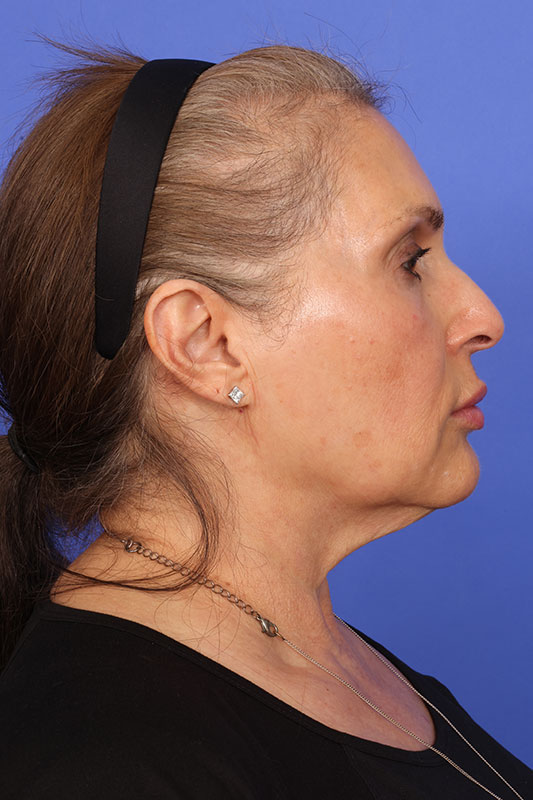 Neck Lift Before & After Image