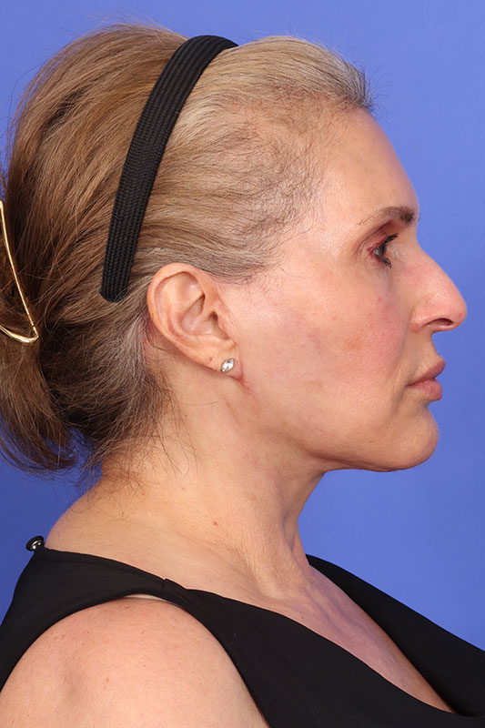 Neck Lift Before & After Image