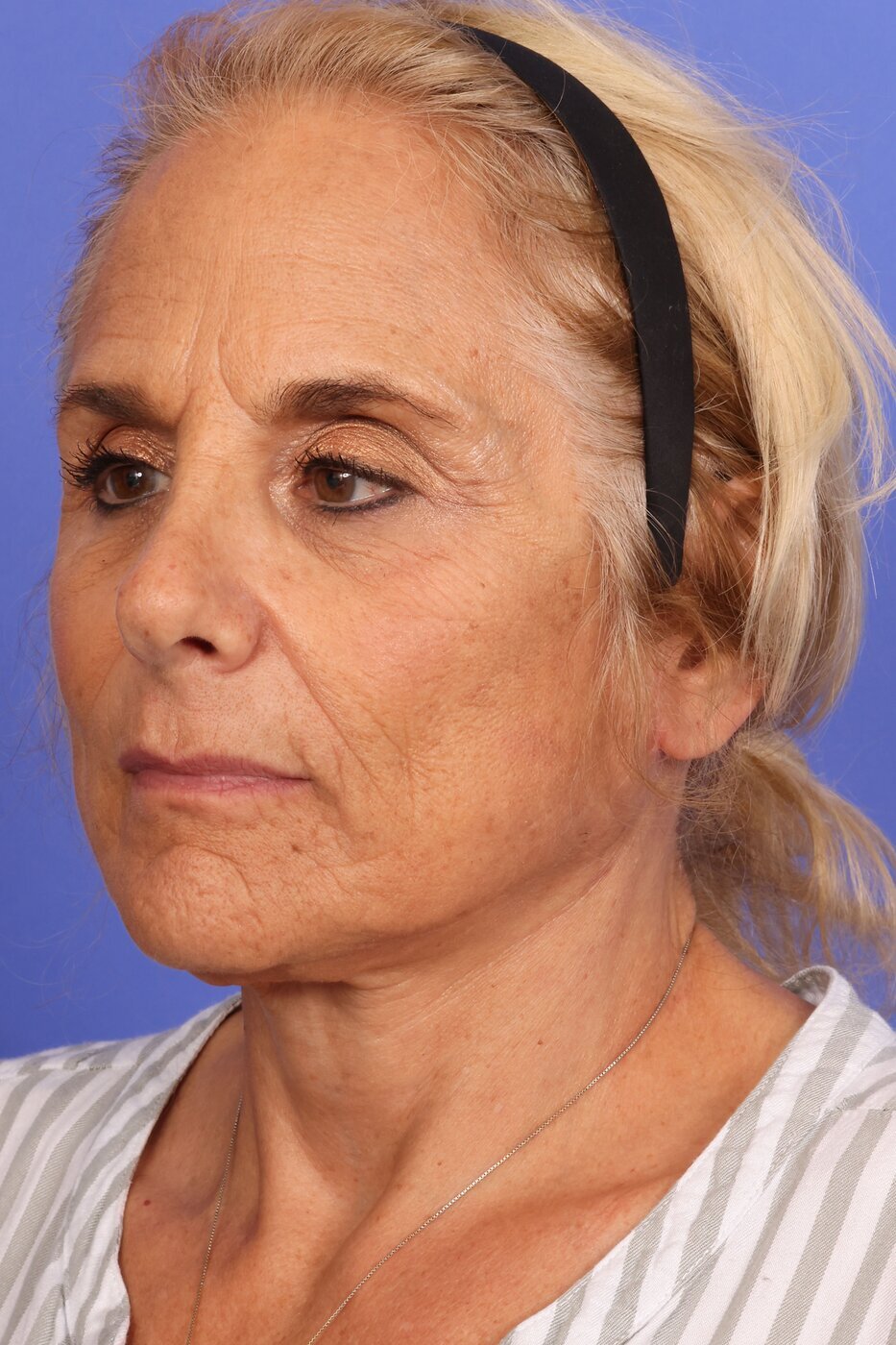 Neck Lift Before & After Image