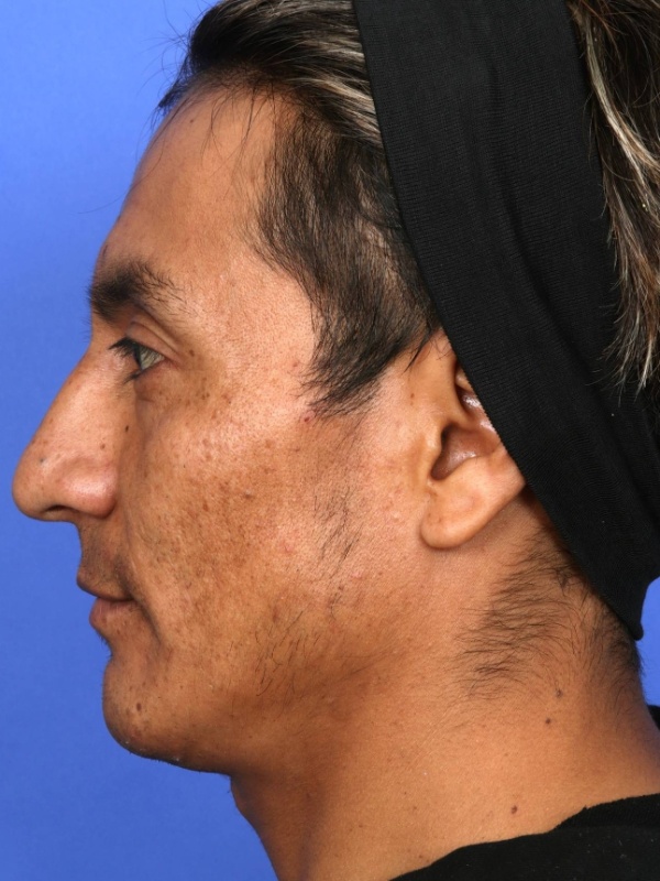 Rhinoplasty Before & After Image