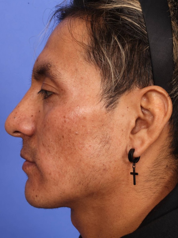 Rhinoplasty Before & After Image