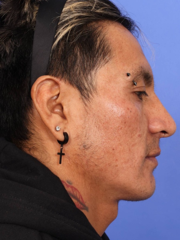 Rhinoplasty Before & After Image