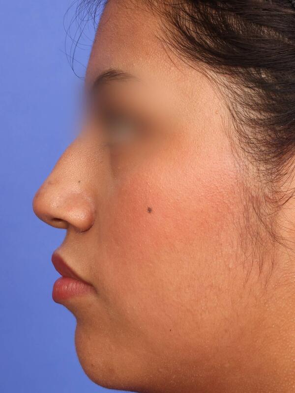 Rhinoplasty Before & After Image