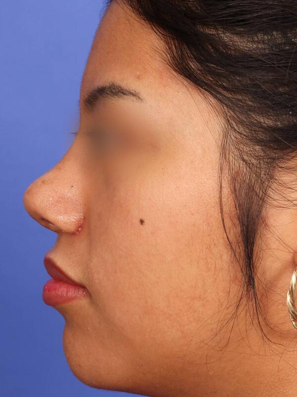 Rhinoplasty Before & After Image