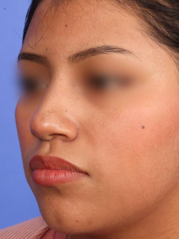 Rhinoplasty Before & After Image