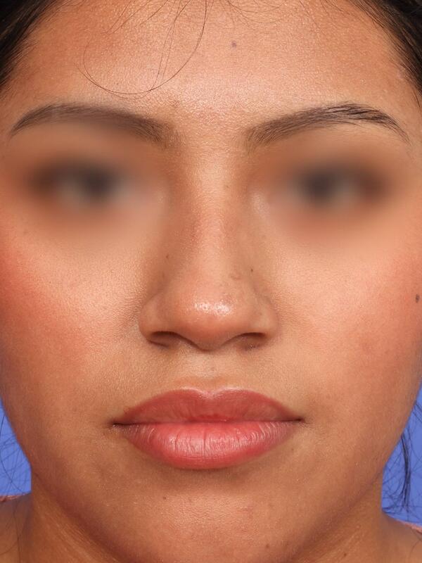 Rhinoplasty Before & After Image