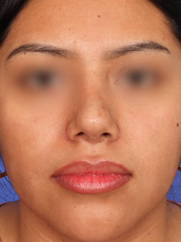 Rhinoplasty Before & After Image