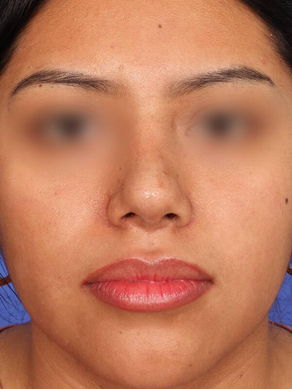 Rhinoplasty Before & After Image