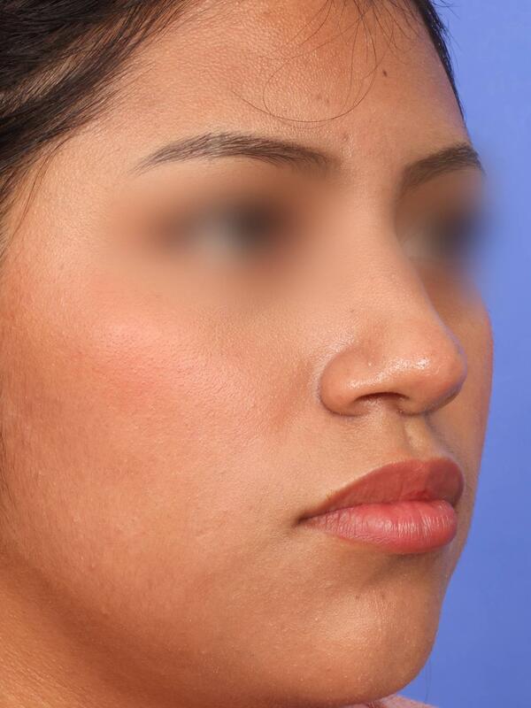 Rhinoplasty Before & After Image