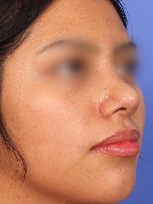 Rhinoplasty Before & After Image