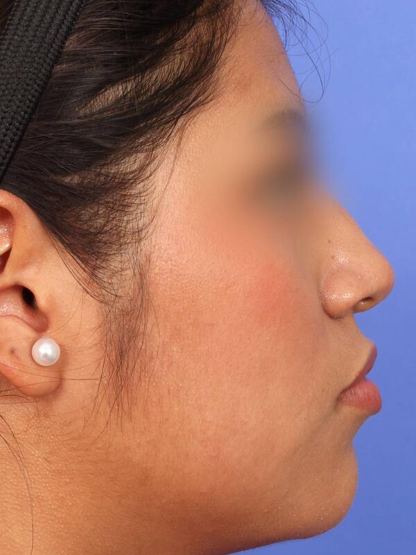 Rhinoplasty Before & After Image