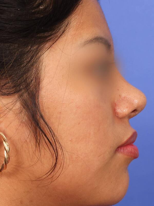 Rhinoplasty Before & After Image