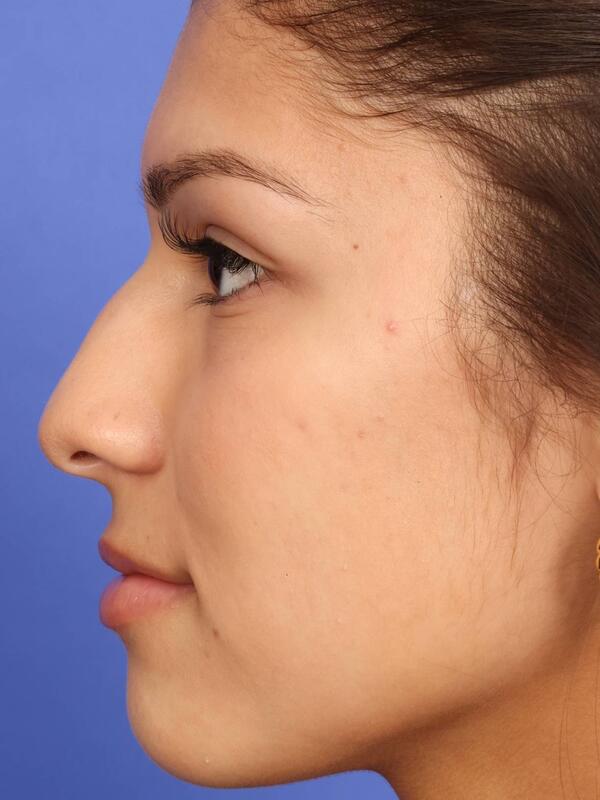 Rhinoplasty Before & After Image