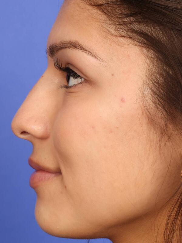 Rhinoplasty Before & After Image