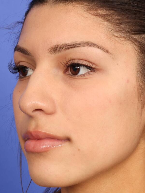 Rhinoplasty Before & After Image