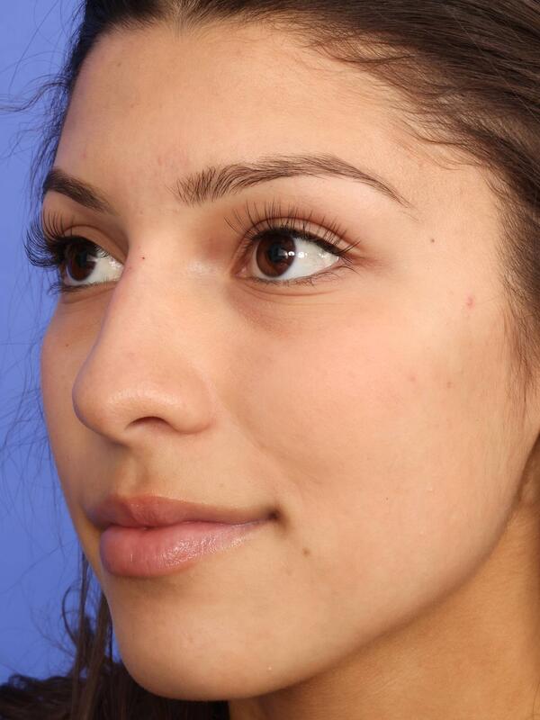 Rhinoplasty Before & After Image