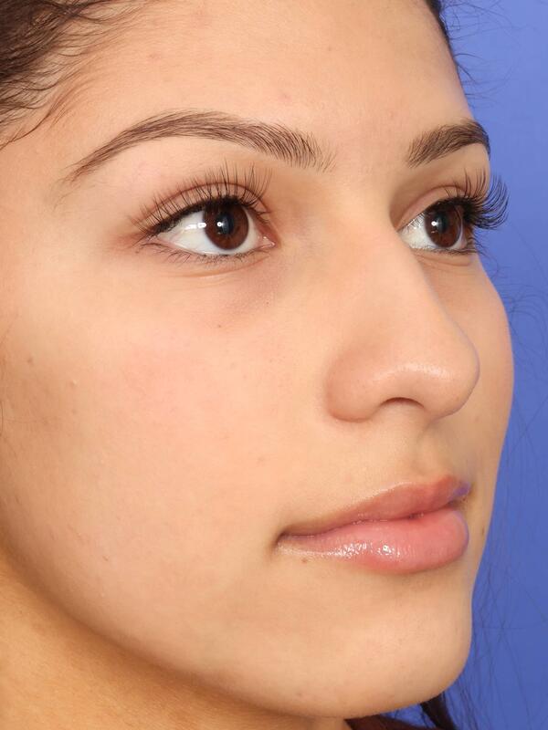 Rhinoplasty Before & After Image