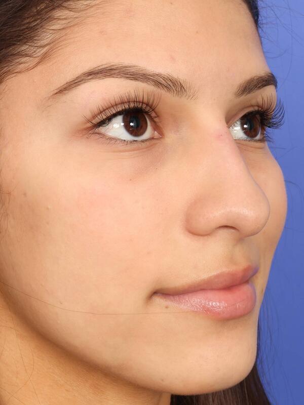 Rhinoplasty Before & After Image