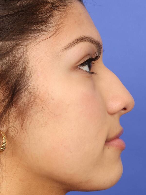 Rhinoplasty Before & After Image