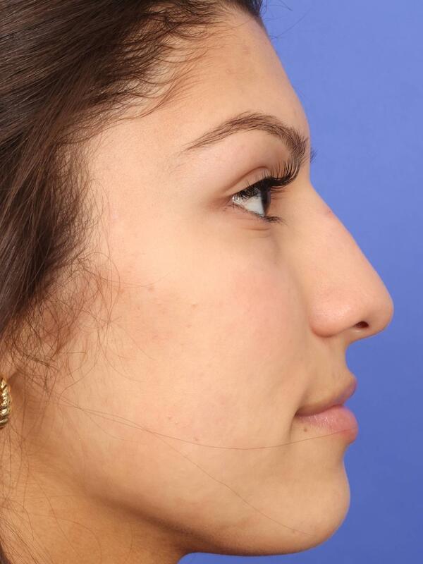 Rhinoplasty Before & After Image