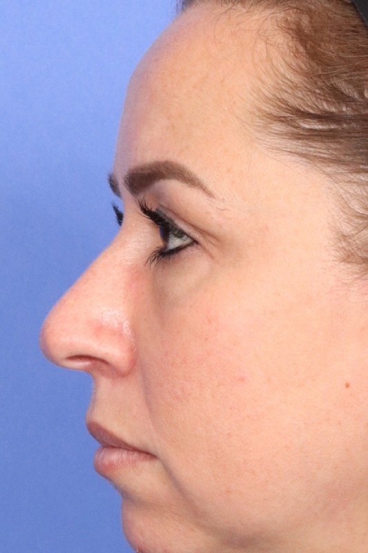 Rhinoplasty Before & After Image