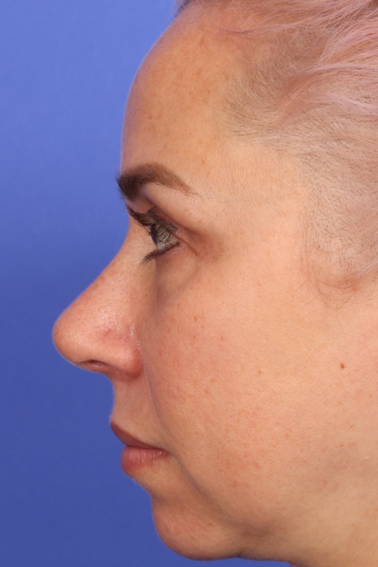 Rhinoplasty Before & After Image