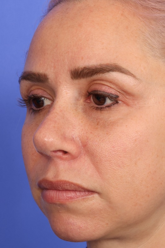 Rhinoplasty Before & After Image