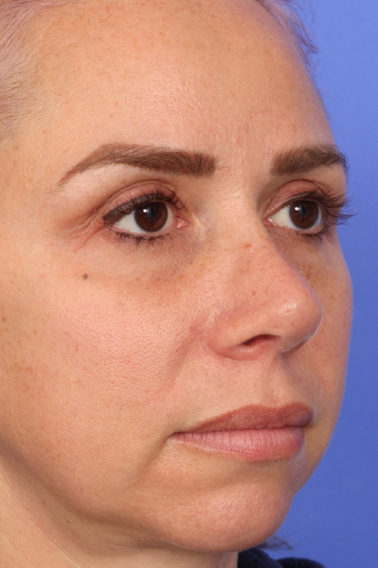 Rhinoplasty Before & After Image