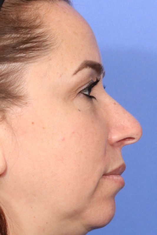 Rhinoplasty Before & After Image