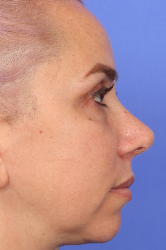 Rhinoplasty Before & After Image