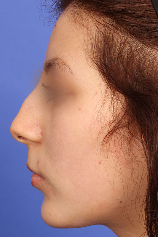 Rhinoplasty Before & After Image