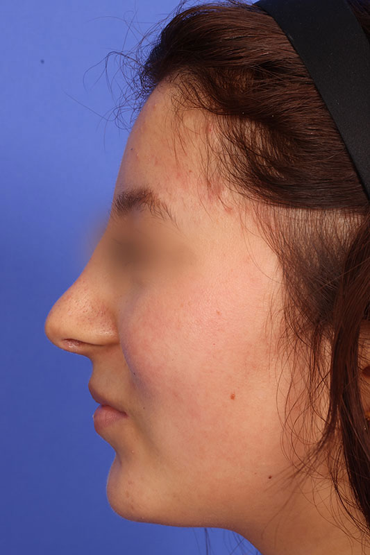 Rhinoplasty Before & After Image