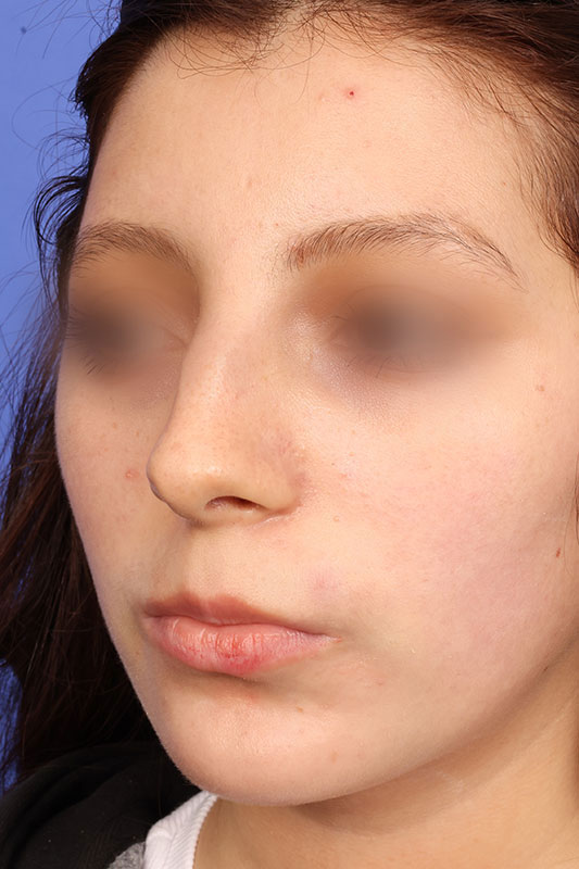 Rhinoplasty Before & After Image