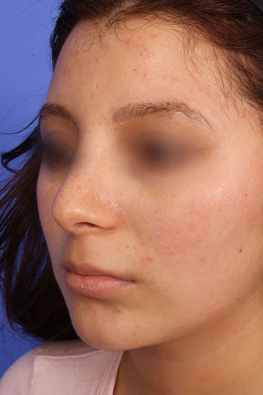 Rhinoplasty Before & After Image