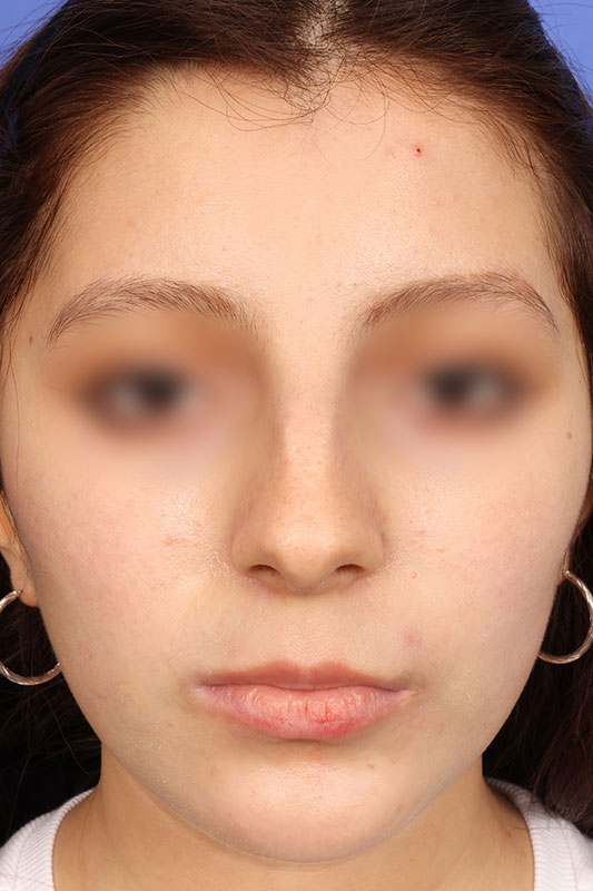 Rhinoplasty Before & After Image