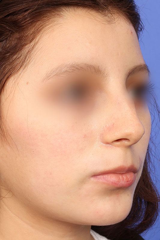 Rhinoplasty Before & After Image