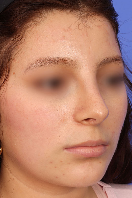 Rhinoplasty Before & After Image