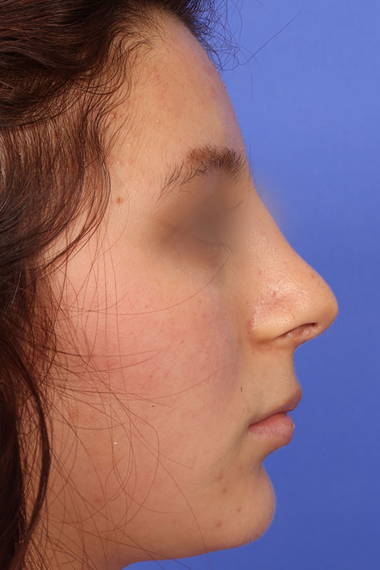 Rhinoplasty Before & After Image