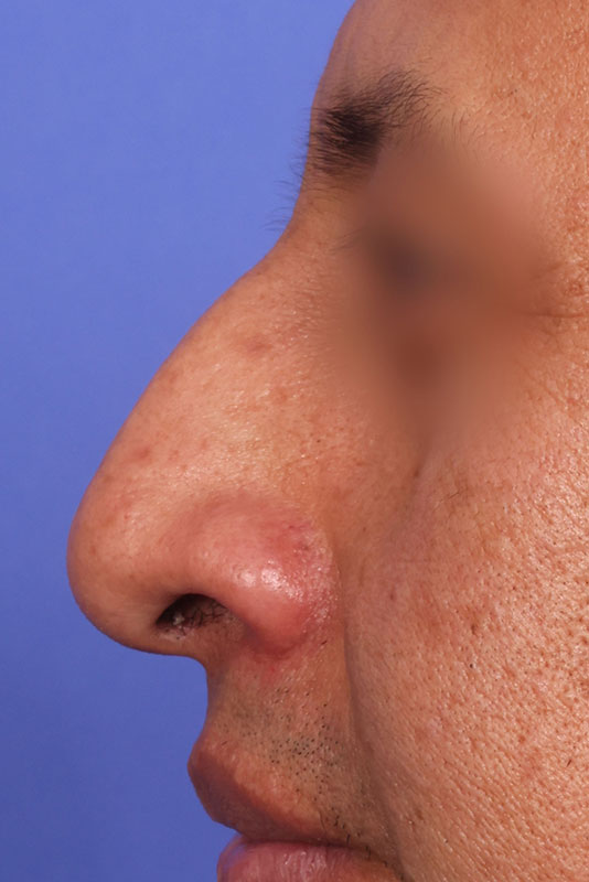 Rhinoplasty Before & After Image